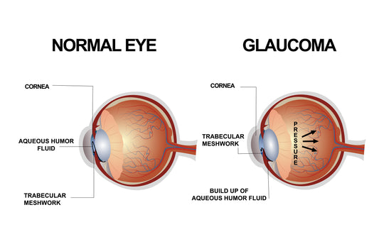 What is Glaucoma? Symptoms and Causes