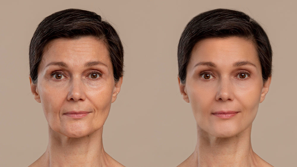 What is Sculptra and How Does it Work Effectively?