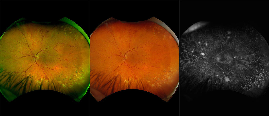 Can Diabetic Retinopathy be Reversed