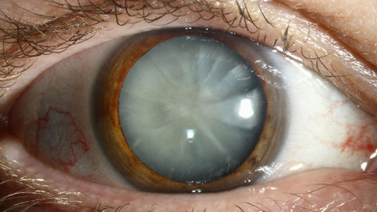 How Long Does It Take to Go Blind from Cataracts?