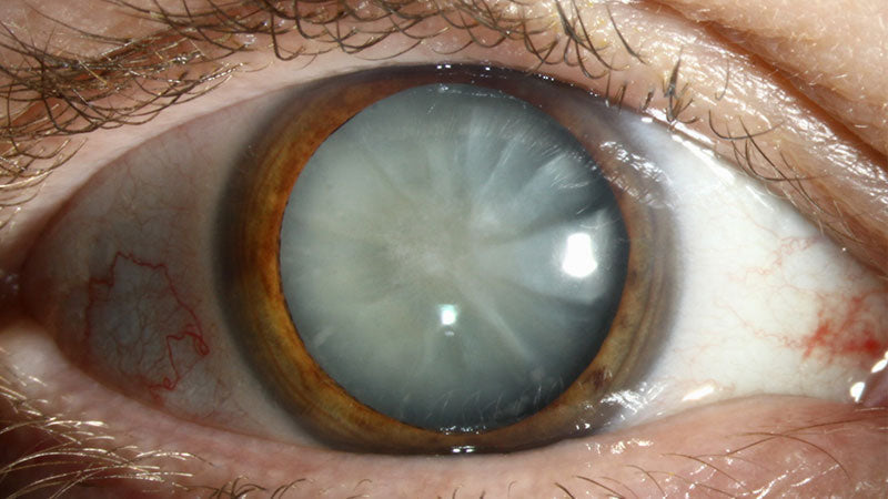 How Long Does It Take to Go Blind from Cataracts