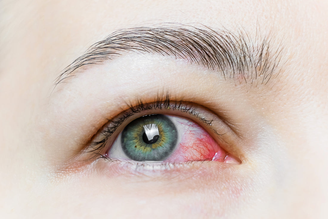 Dry Eyes: Symptoms and Causes