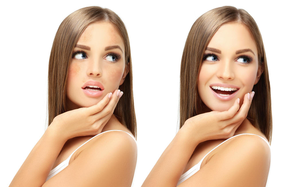 What is the Difference Between Hyperpigmentation and Melasma