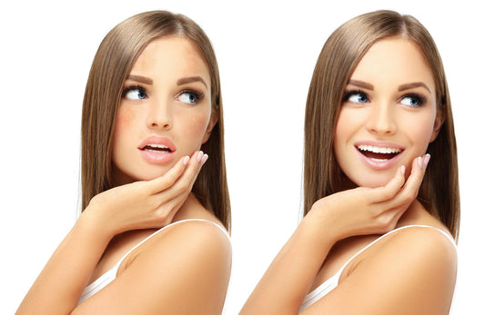 What is the Difference Between Hyperpigmentation and Melasma